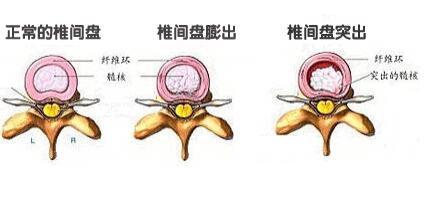 腰椎間盤膨出