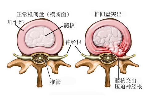 腰椎間盤突出